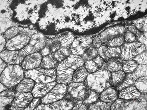 F, 32y. | oncocytic parathyreoideal adenoma